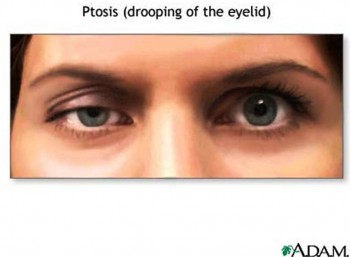 2. Eyelid Drooping e1319735474637 10 Things That You Probably Dont Know About Muscular Dystrophy   [FACTS]