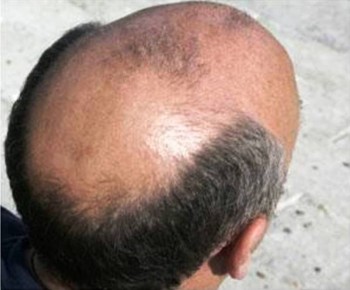 4. Baldness In Front of the Head e1319735345843 10 Things That You Probably Dont Know About Muscular Dystrophy   [FACTS]