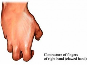 7. Joint Contractures Could Develop e1319735200253 10 Things That You Probably Dont Know About Muscular Dystrophy   [FACTS]