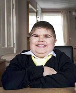 8. It could cause Obesity e1319735155806 10 Things That You Probably Dont Know About Muscular Dystrophy   [FACTS]