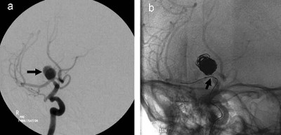 8. Treatment for Complex Aneurysm e1351834189601 Top 10 Medical Innovations in 2013